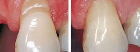 Патология чаще всего поражает фронтальные зубы и премоляры
